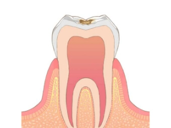 進行度2段階目の虫歯