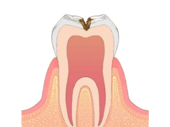 進行度3段階目の虫歯