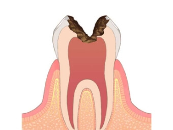 進行度4段階目の虫歯