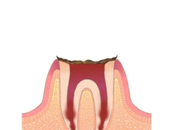 進行度5段階目の虫歯